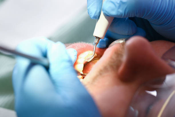 Best Urgent Care for Lost Fillings or Crowns in North Ballston Spa, NY